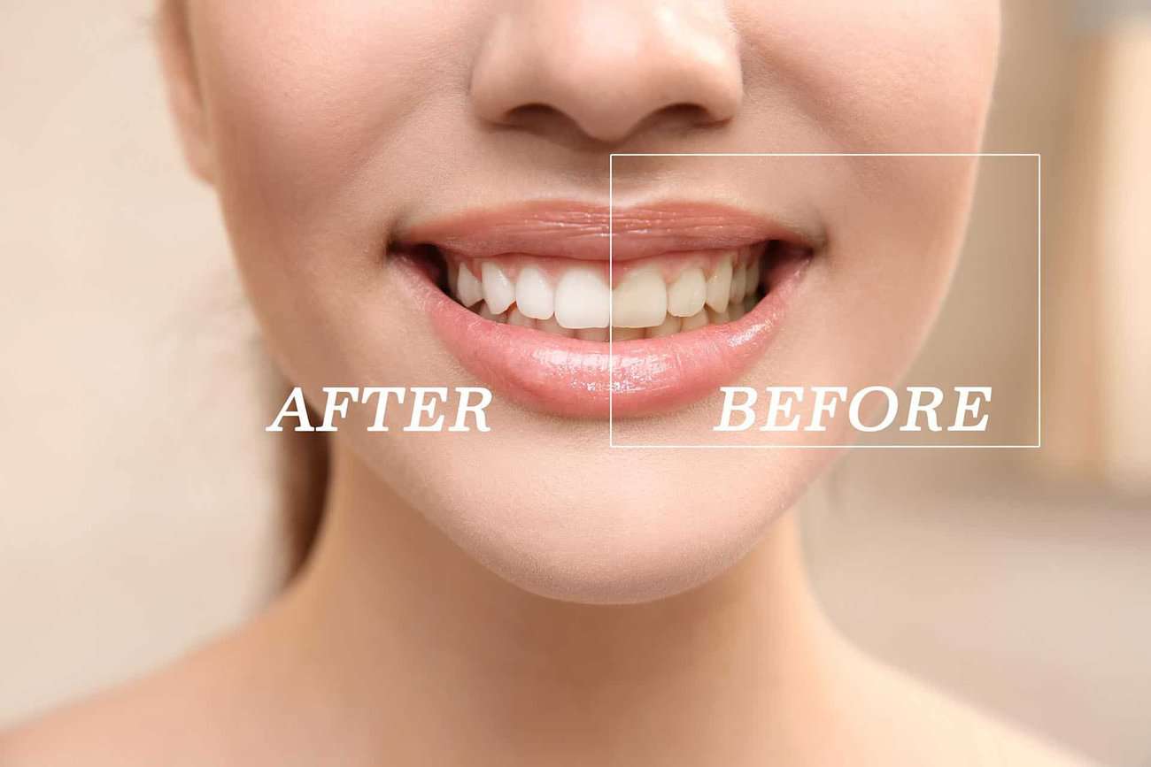 How Can You Maintain a Consistent Smile Shade with Crowns Gillingham?