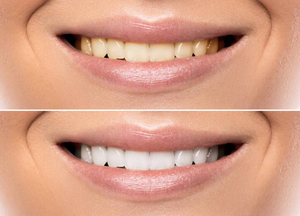 How Does Gum Disease Progress if Left Untreated Gillingham?