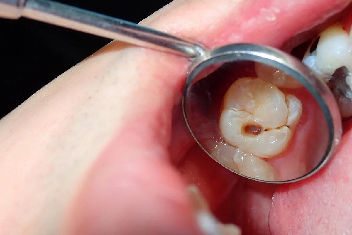 Why Do Teeth Crack? Common Causes to Know Gillingham