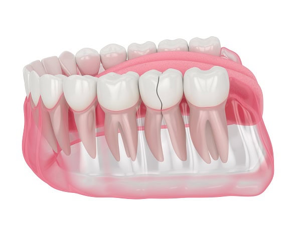 How Can You Manage Pain and Discomfort After a Root Canal Gillingham?