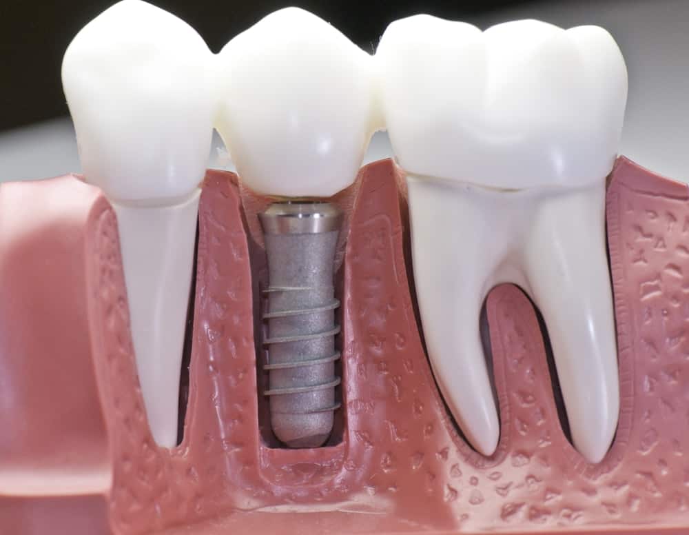 Common Misconceptions About Modern Dental Treatments Gillingham