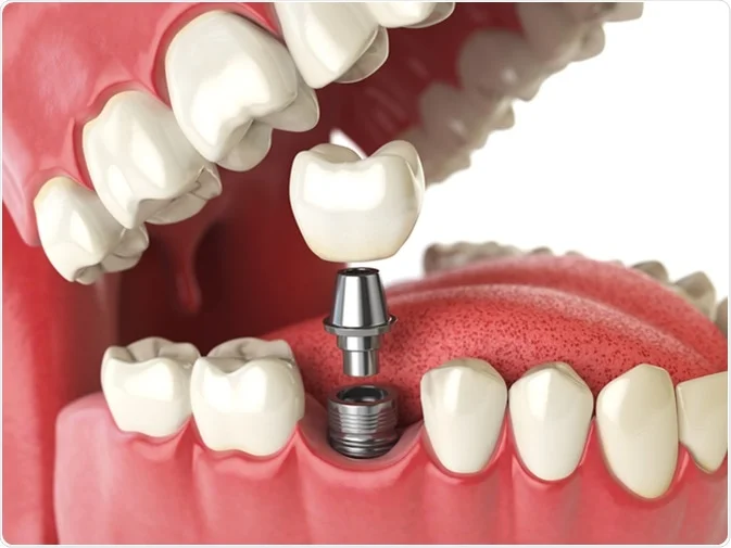 How Do I Decide Which Tooth Replacement Is Right for Me Gillingham?