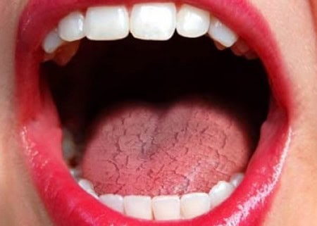 Common Causes of Dry Mouth (Xerostomia) Gillingham