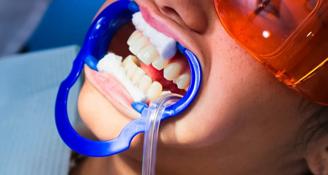 How Teeth Whitening Treatments Actually Work on Your Enamel Gillingham