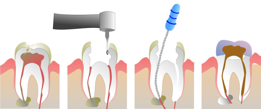 How Do You Properly Care for Your Teeth After a Root Canal Gillingham