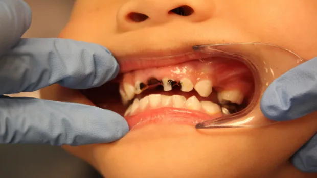 Tips for Keeping Your Child’s Baby Teeth Healthy and Strong Gillingham