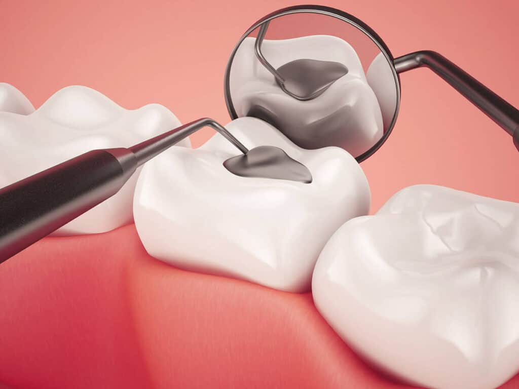 How Can You Prevent Tooth Decay Effectively Gillingham