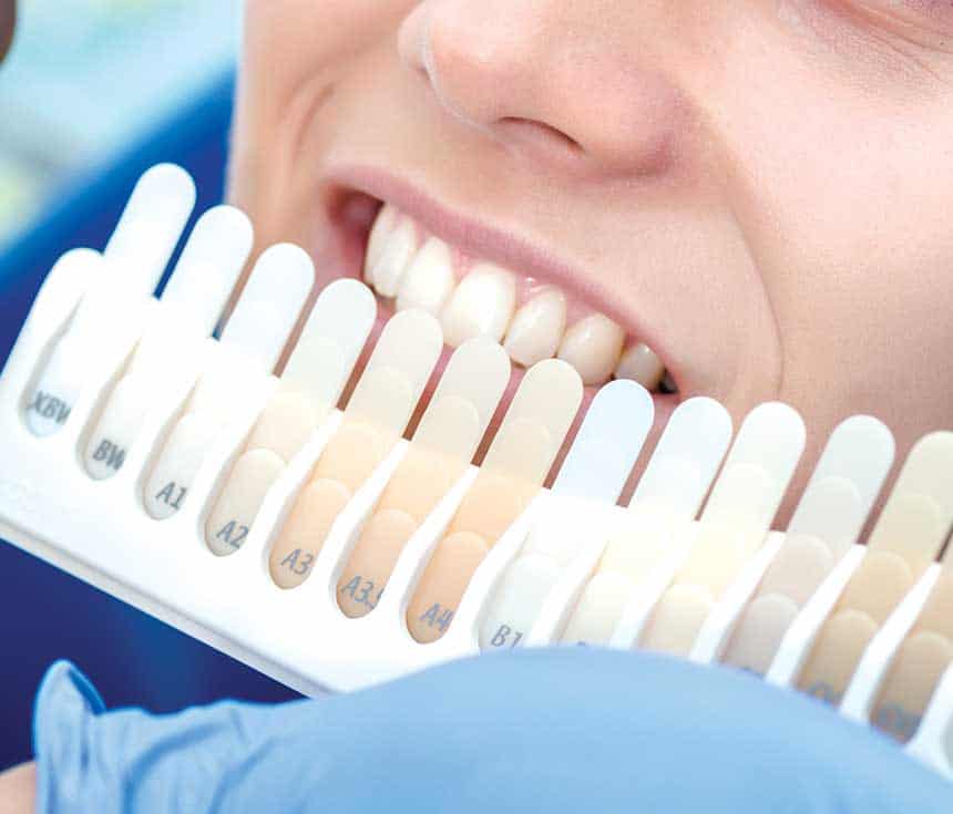 Professional vs At-Home Whitening: What You Need to Know Gillingham