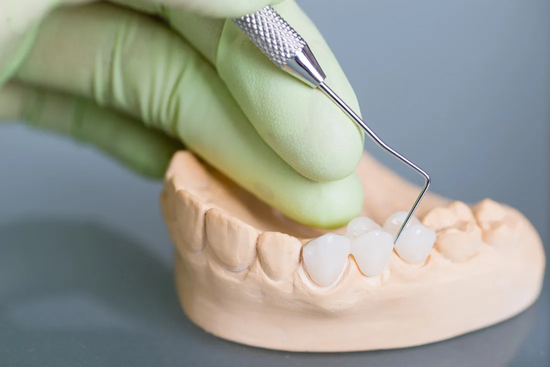 What Are the Different Types of Dental Crowns Available Gillingham?