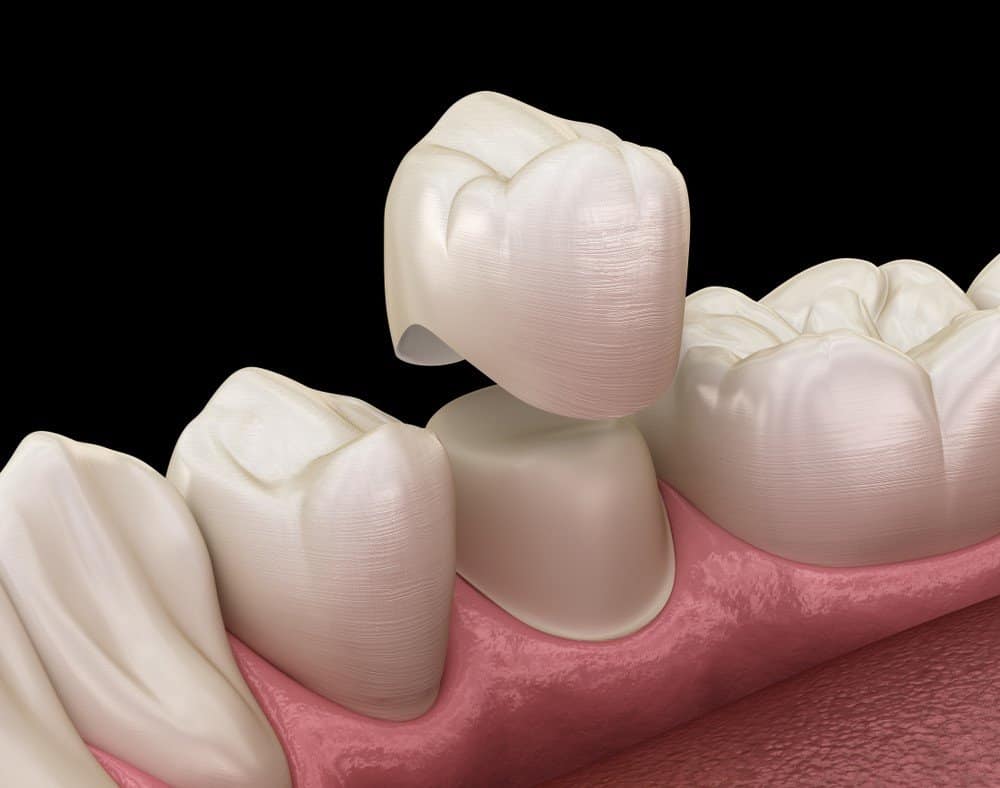Teeth Whitening: Separating Facts from Fiction Gillingham