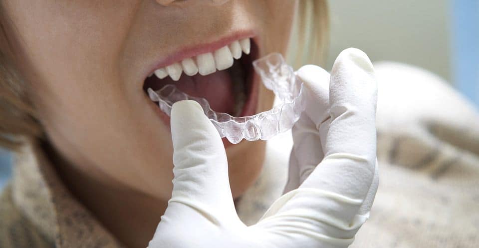 Can Bruxism Affect Your Sleep Quality Gillingham