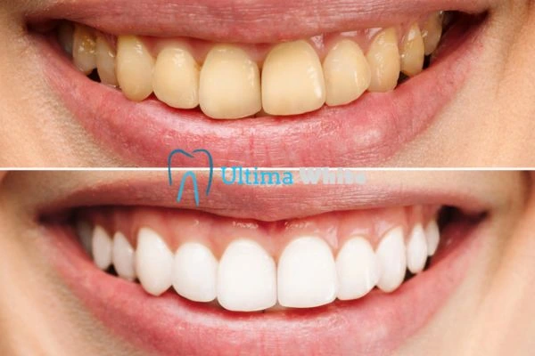 Oral Care Tips for Current and Former Smokers Gillingham