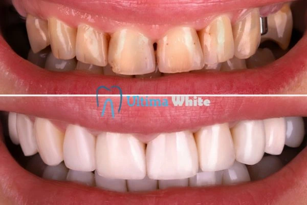 What Makes Instant Teeth Whitening Treatments So Popular Gillingham?