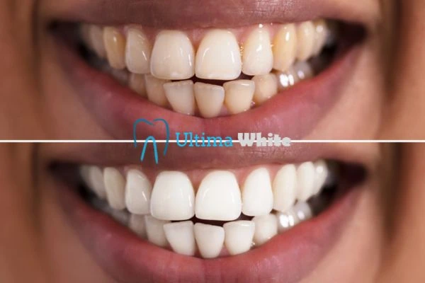 Aftercare Tips to Maintain Your New Smile Gillingham